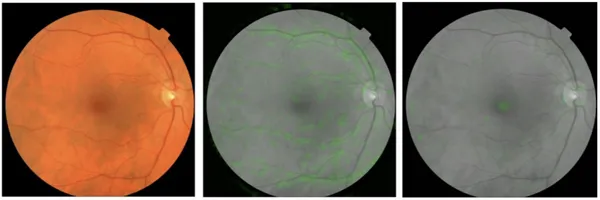 google-retinal-fundus-images-cv-risk-prediction.pn