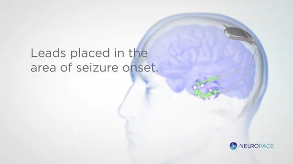 NeuroPace.png