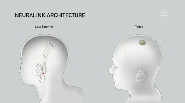 Neuralink implant