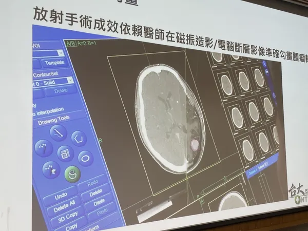 醫隼智慧_台大醫院AI腫瘤圈選