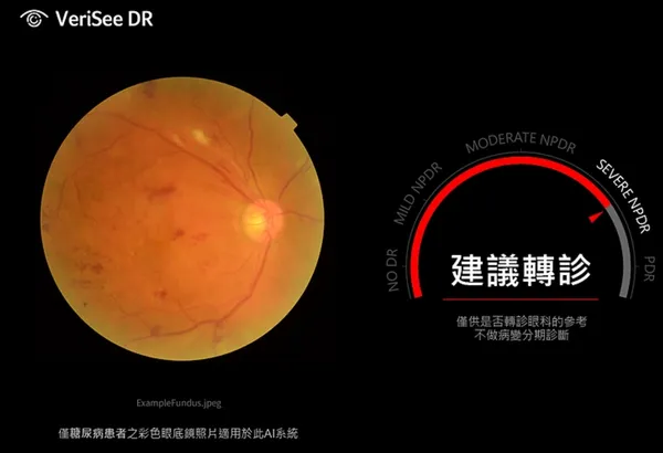 換照1_宏碁智醫  糖尿病篩檢眼底鏡