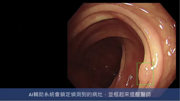 大腸鏡即時AI瘜肉偵測 aetherAI Endo