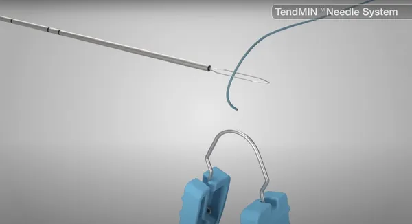 艾斯創生醫TendMIN™ Telescoping Needle.jpg